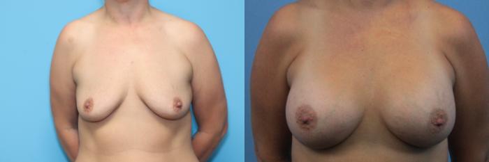 Before & After Breast Lift Case 285 Front View in West Des Moines, IA
