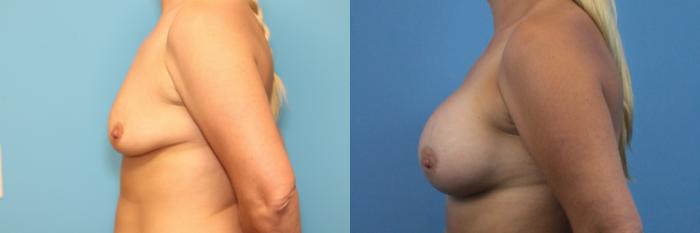 Before & After Breast Lift Case 285 Left Side View in West Des Moines & Ames, IA