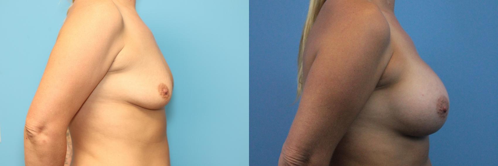 Before & After Breast Augmentation Case 285 Right Side View in West Des Moines, IA