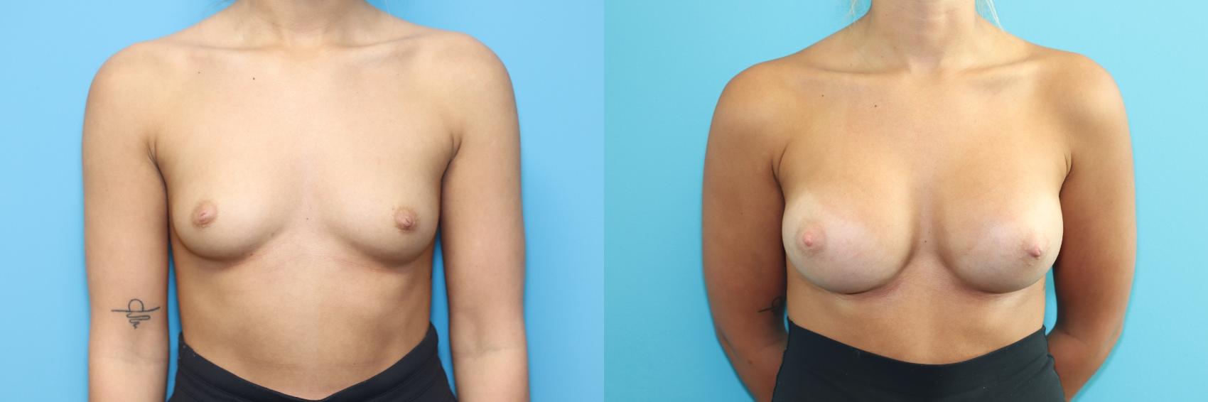 Before & After Breast Augmentation Case 286 Front View in West Des Moines, IA