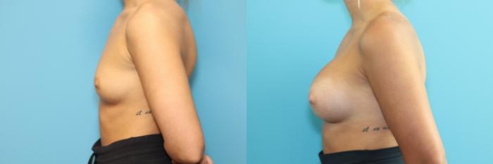 Before & After Breast Augmentation Case 286 Left Side View in West Des Moines & Ames, IA