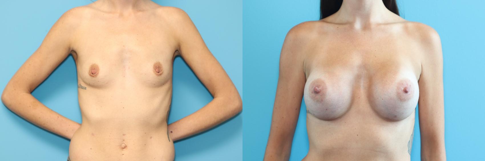 Before & After Breast Augmentation Case 288 Front View in West Des Moines & Ames, IA