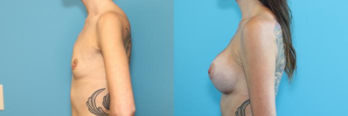 Before & After Breast Augmentation Case 288 Left Side View in West Des Moines & Ames, IA