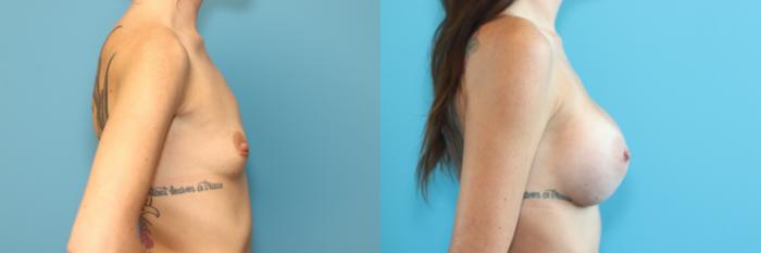 Before & After Breast Augmentation Case 288 Right Side View in West Des Moines & Ames, IA