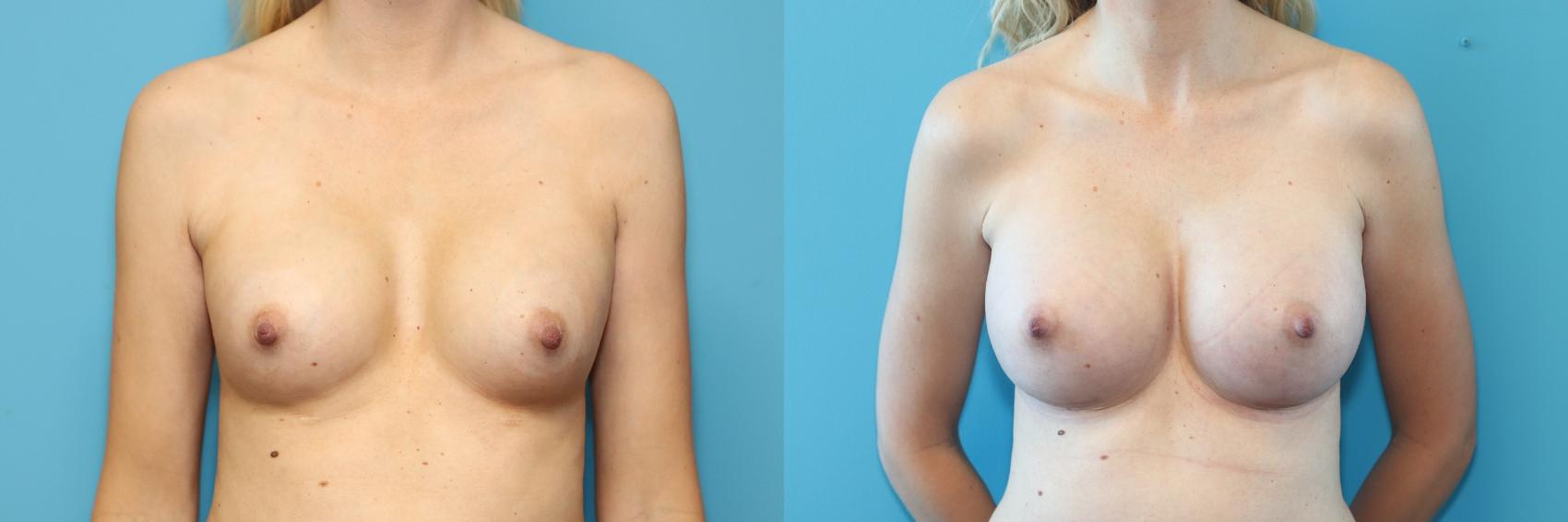 Before & After Breast Augmentation Case 294 Front View in West Des Moines, IA