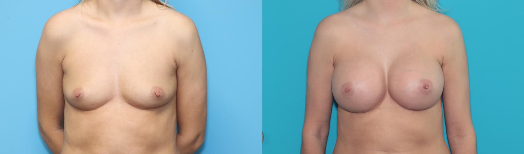 Dr. Carlisle used a 450cc silicone implant on right and 415cc implant on the left to make the breasts more symmetric.