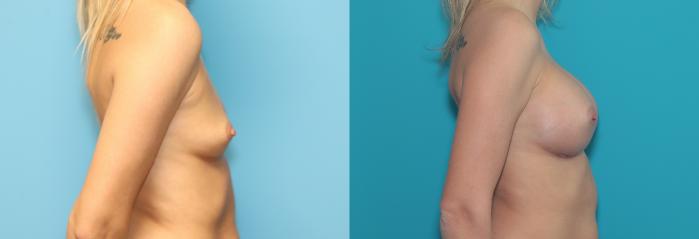 Before & After Breast Augmentation Case 296 Right Side View in West Des Moines & Ames, IA