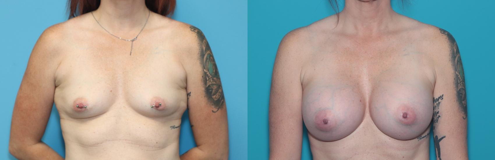 Before & After Breast Augmentation Case 299 Front View in West Des Moines & Ames, IA