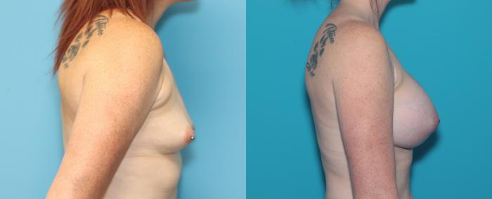 Before & After Breast Augmentation Case 299 Right Side View in West Des Moines & Ames, IA