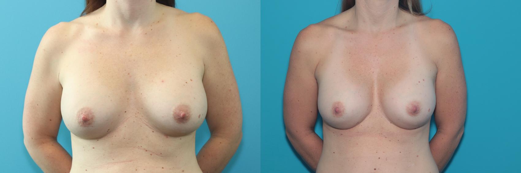 Before & After Breast Augmentation Case 301 Front View in West Des Moines & Ames, IA