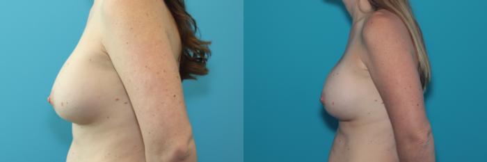 Before & After Breast Augmentation Case 301 Left Side View in West Des Moines & Ames, IA