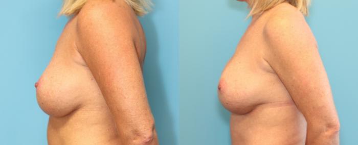 Before & After Breast Augmentation Case 314 Left Side View in West Des Moines & Ames, IA