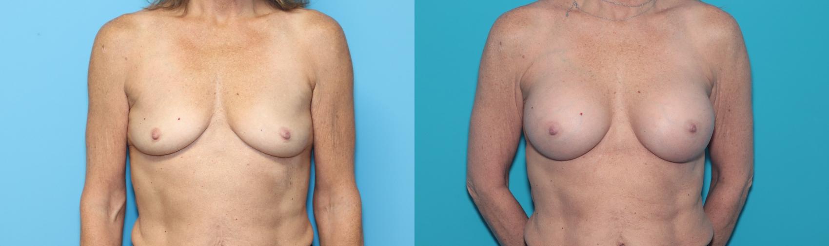 Before & After Breast Augmentation Case 327 Front View in West Des Moines & Ames, IA