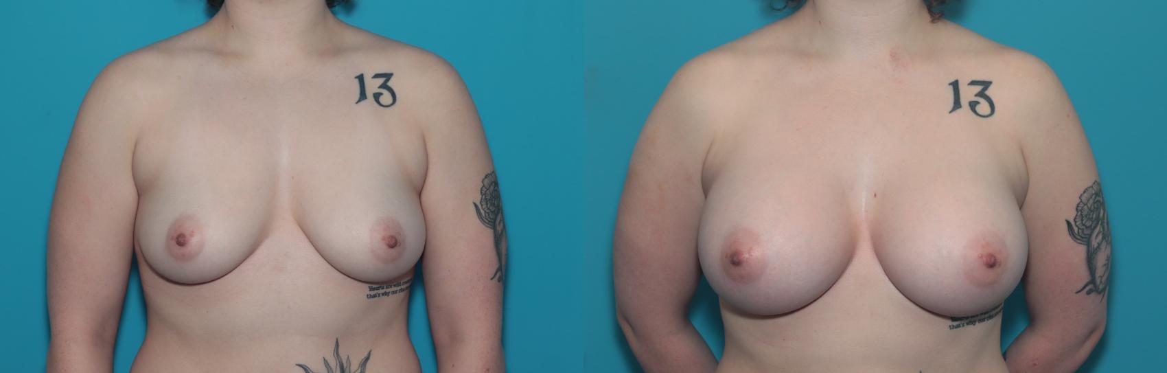 Before & After Breast Augmentation Case 340 Front View in West Des Moines & Ames, IA