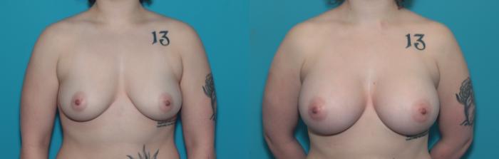 Before & After Breast Augmentation Case 340 Front View in West Des Moines, IA