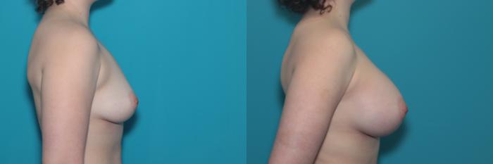 Before & After Breast Augmentation Case 340 Right Side View in West Des Moines & Ames, IA
