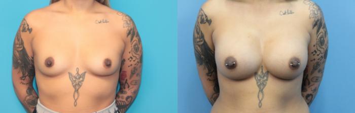 Before & After Breast Augmentation Case 346 Front View in West Des Moines & Ames, IA