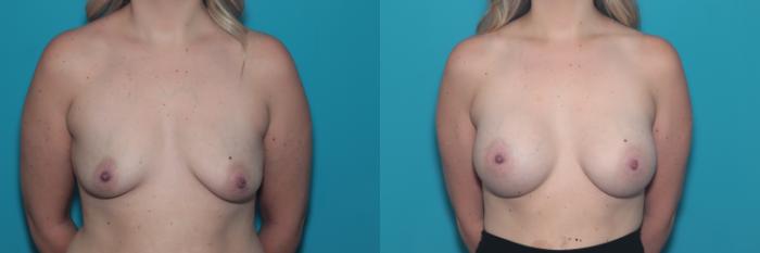 Before & After Breast Augmentation Case 348 Front View in West Des Moines & Ames, IA