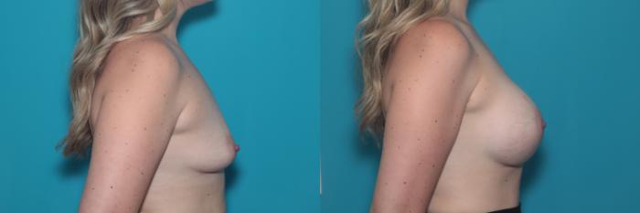 Before & After Breast Augmentation Case 348 Right Side View in West Des Moines & Ames, IA