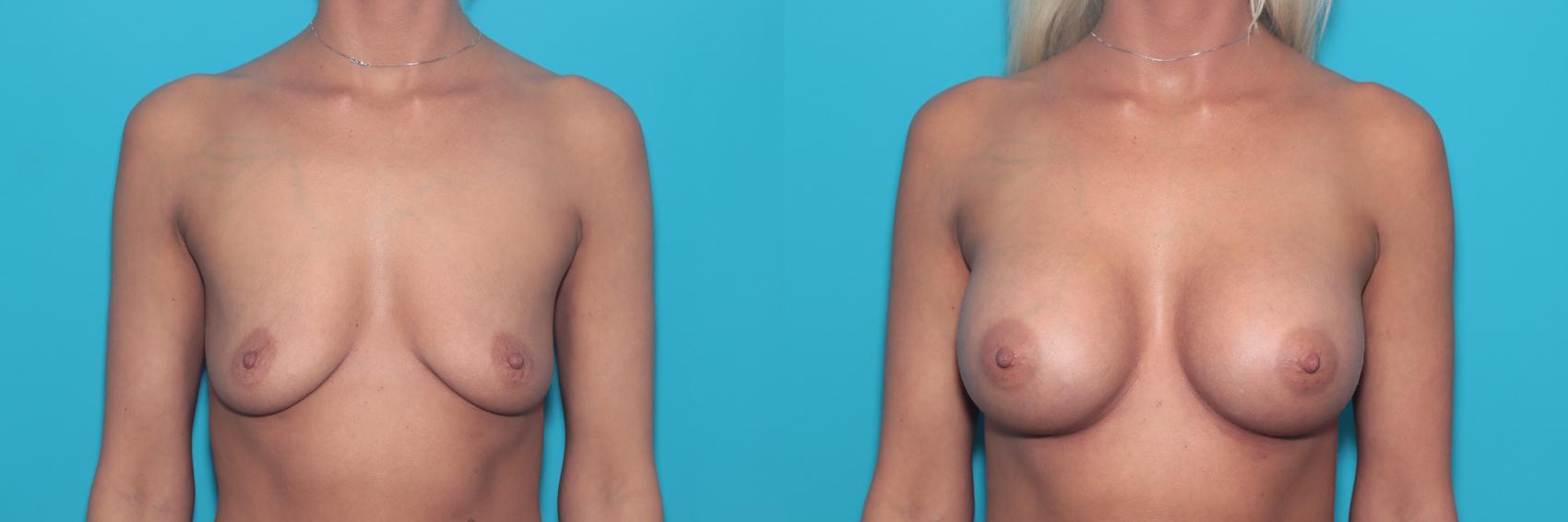 Before & After Breast Augmentation Case 360 Front View in West Des Moines, IA
