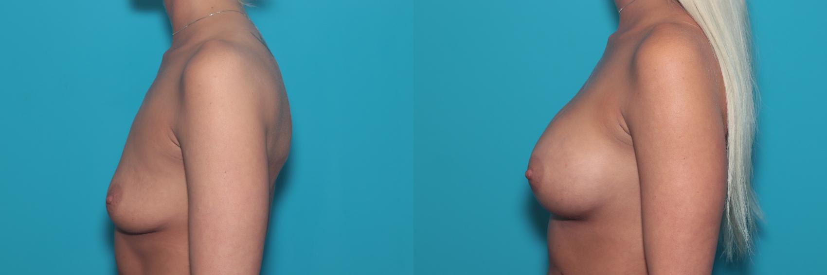 Before & After Breast Augmentation Case 360 Left Side View in West Des Moines, IA