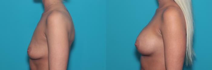 Before & After Breast Augmentation Case 360 Left Side View in West Des Moines & Ames, IA