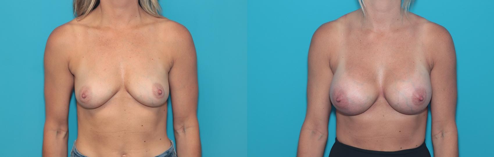 Before & After Breast Augmentation Case 370 Front View in West Des Moines, IA