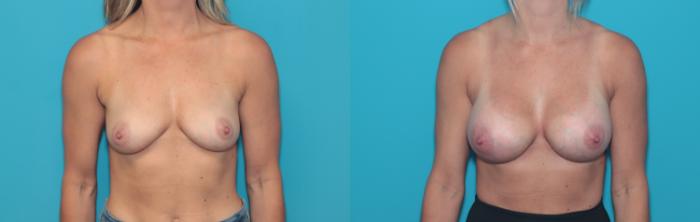 Before & After Breast Augmentation Case 370 Front View in West Des Moines & Ames, IA