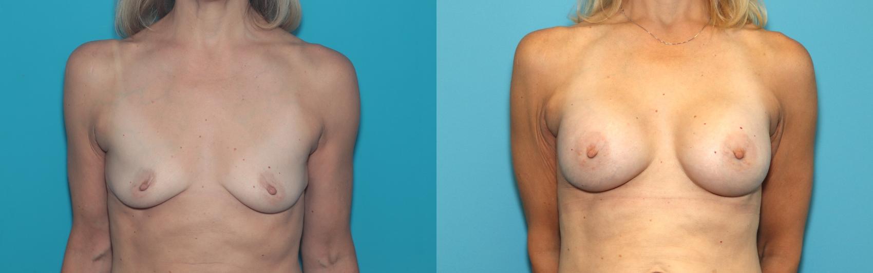 Before & After Breast Augmentation Case 375 Front View in West Des Moines & Ames, IA