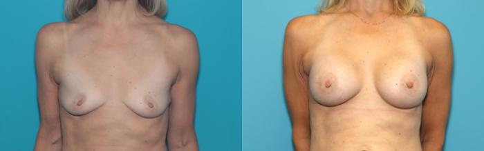 Before & After Breast Augmentation Case 375 Front View in West Des Moines & Ames, IA