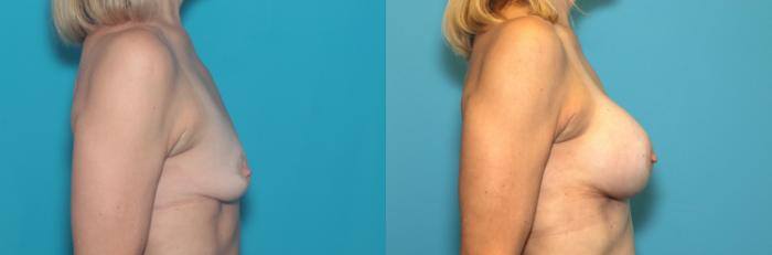 Before & After Breast Augmentation Case 375 Right Side View in West Des Moines & Ames, IA