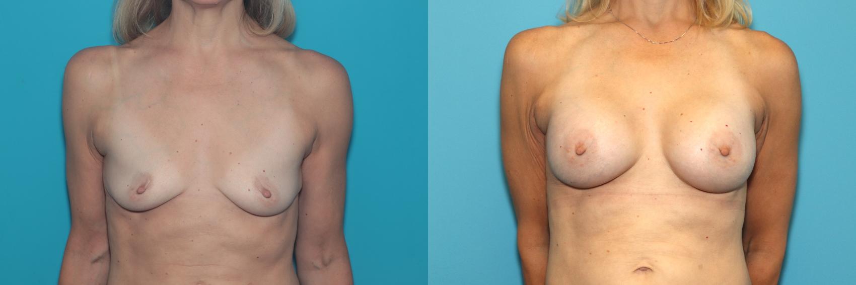 Before & After Breast Augmentation Case 377 Front View in West Des Moines & Ames, IA