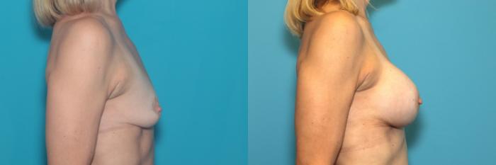Before & After Breast Augmentation Case 377 Right Side View in West Des Moines & Ames, IA