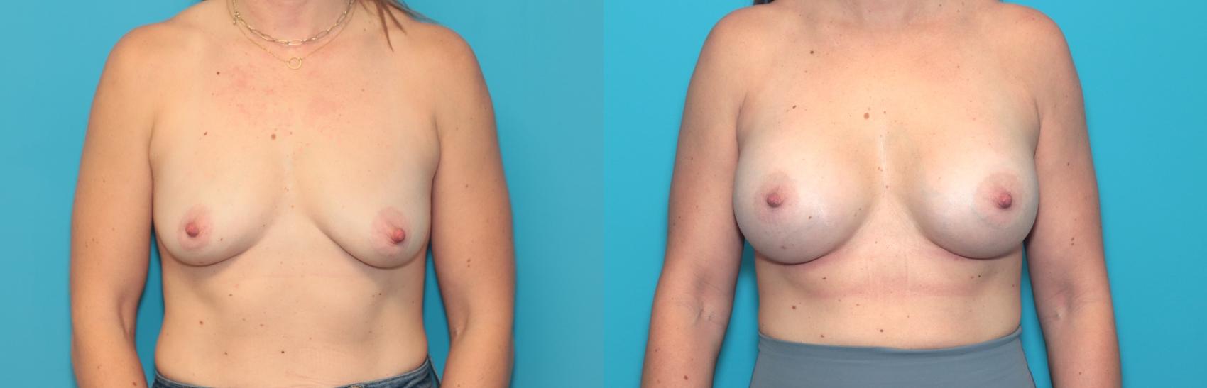 Before & After Breast Augmentation Case 379 Front View in West Des Moines & Ames, IA