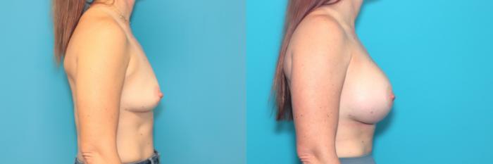 Before & After Breast Augmentation Case 379 Right Side View in West Des Moines & Ames, IA