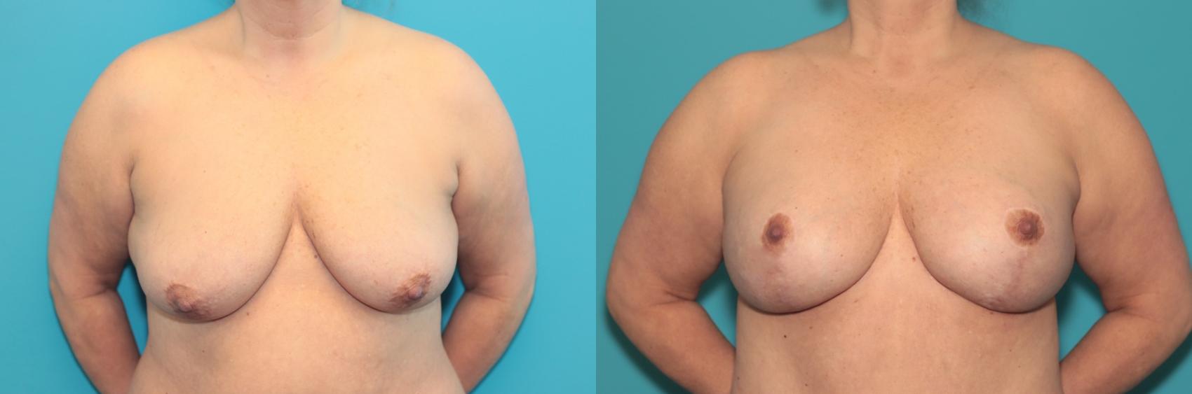 Before & After Breast Augmentation Case 386 Front View in West Des Moines & Ames, IA