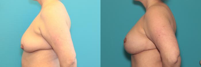 Before & After Breast Lift Case 386 Left Side View in West Des Moines & Ames, IA