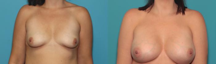 Before & After Breast Augmentation Case 392 Front View in West Des Moines & Ames, IA