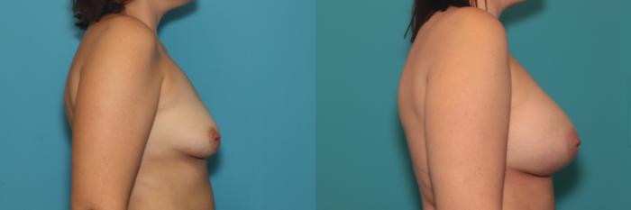 Before & After Breast Augmentation Case 392 Right Side View in West Des Moines & Ames, IA