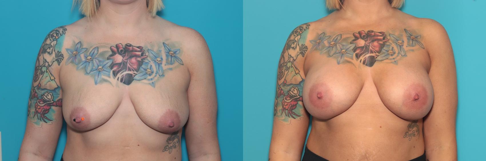 Before & After Breast Augmentation Case 406 Front View in West Des Moines & Ames, IA