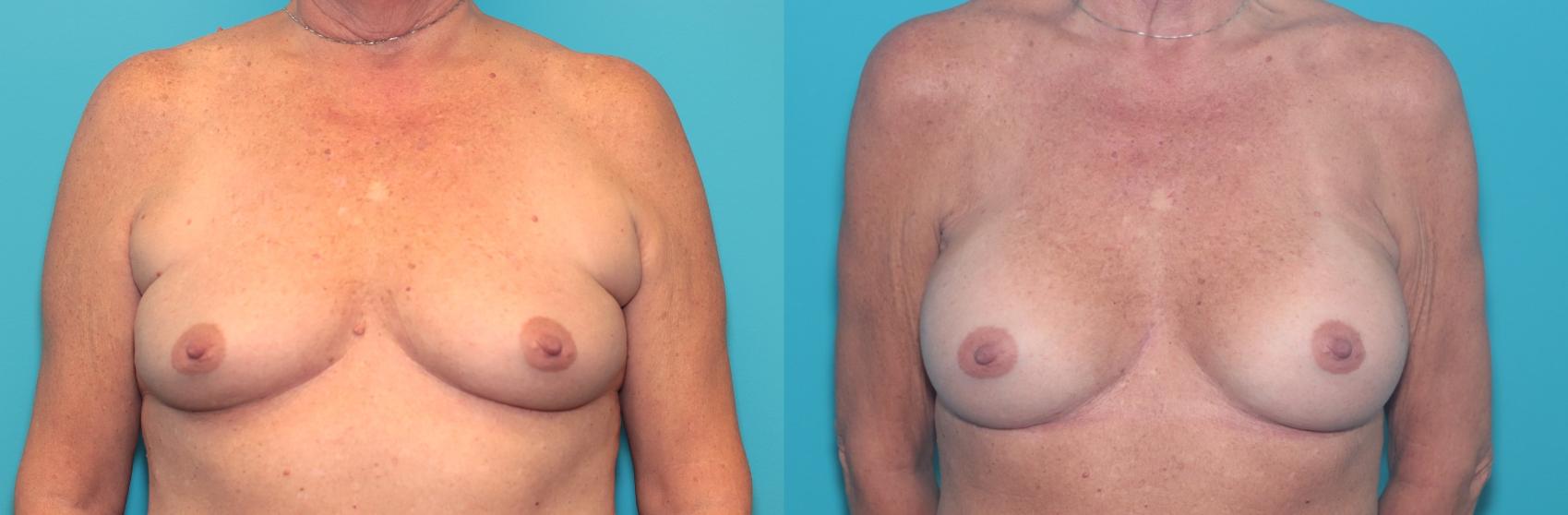 Before & After Breast Augmentation Case 409 Front View in West Des Moines & Ames, IA