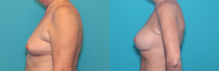 Before & After Breast Augmentation Case 409 Left Side View in West Des Moines & Ames, IA