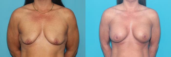 Before & After Breast Augmentation Case 413 Front View in West Des Moines & Ames, IA