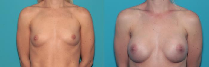 Before & After Breast Augmentation Case 423 Front View in West Des Moines & Ames, IA