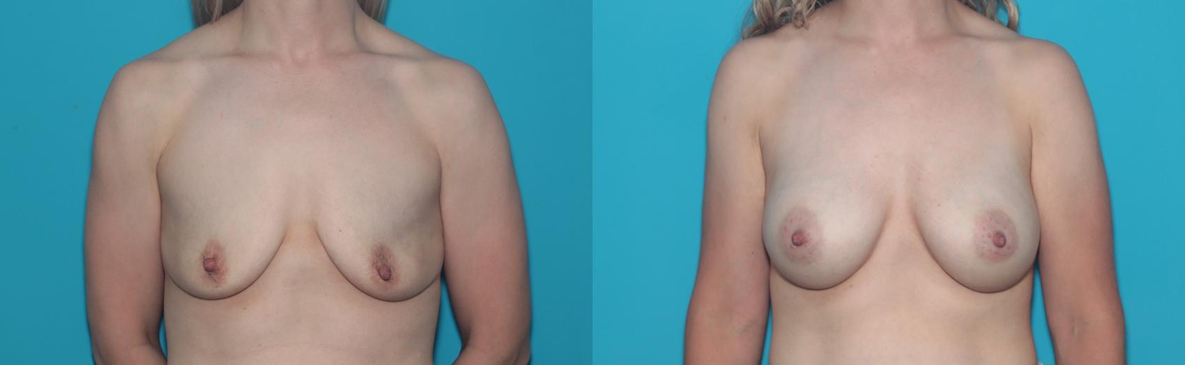 Before & After Breast Augmentation Case 427 Front View in West Des Moines & Ames, IA