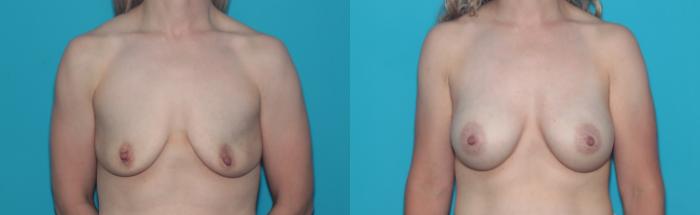 Before & After Breast Augmentation Case 427 Front View in West Des Moines & Ames, IA