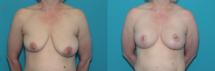 Before & After Liposuction/ Fat Transfer/ Brazilian Butt Lift Case 441 Front View in West Des Moines & Ames, IA