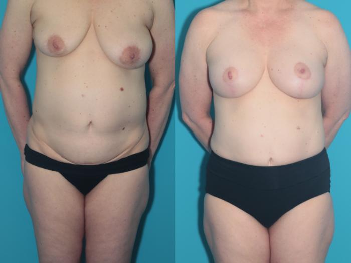 Before & After Breast Augmentation Case 441 Full Front  View in West Des Moines & Ames, IA