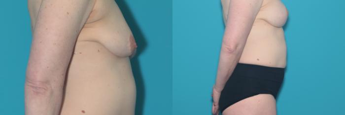 Before & After Breast Augmentation Case 441 Right Side View in West Des Moines & Ames, IA