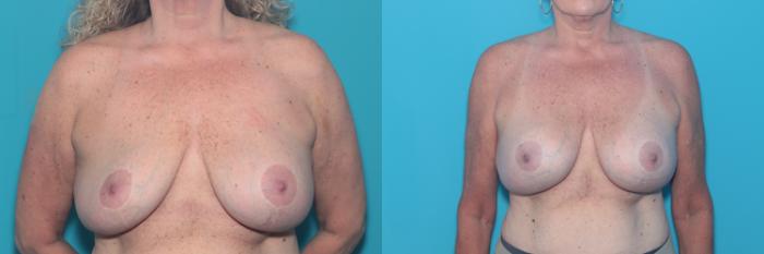 Before & After Breast Augmentation Case 442 Front View in West Des Moines & Ames, IA